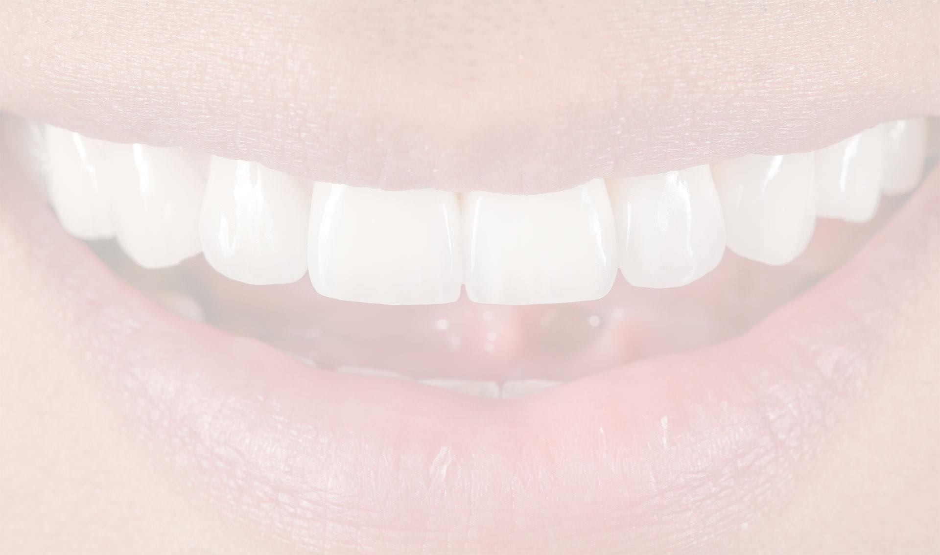 Answers to Your Questions About Porcelain Veneers