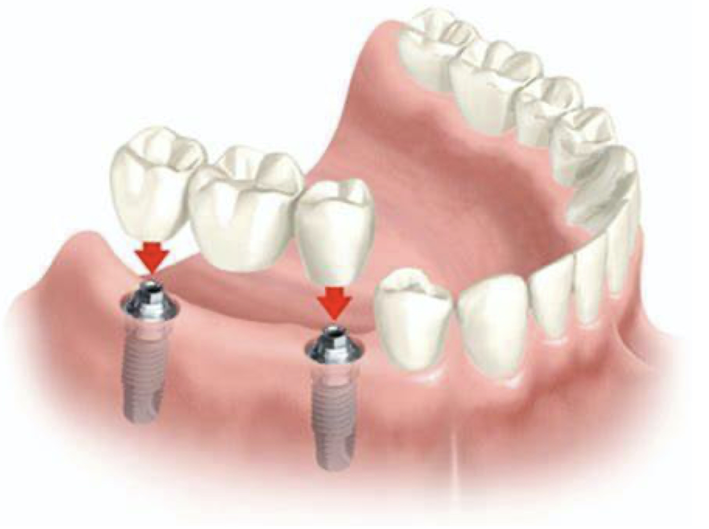 Implant Bridge