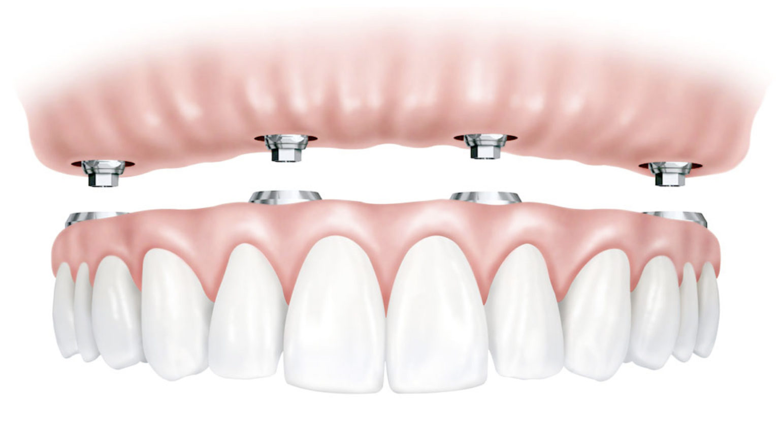 Allon4 Dental Implants University Associates in Dentistry Allon4 Dental Implants University Associates in Dentistry