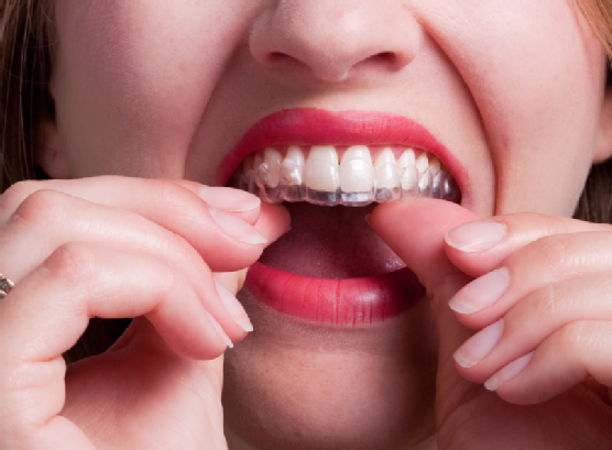 Woman Putting Plastic Dental Retainer on Teeth