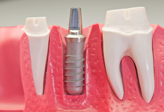 Dental Implant Model without the crown