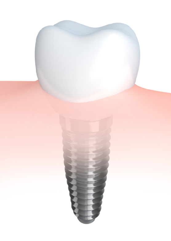 Dental implant