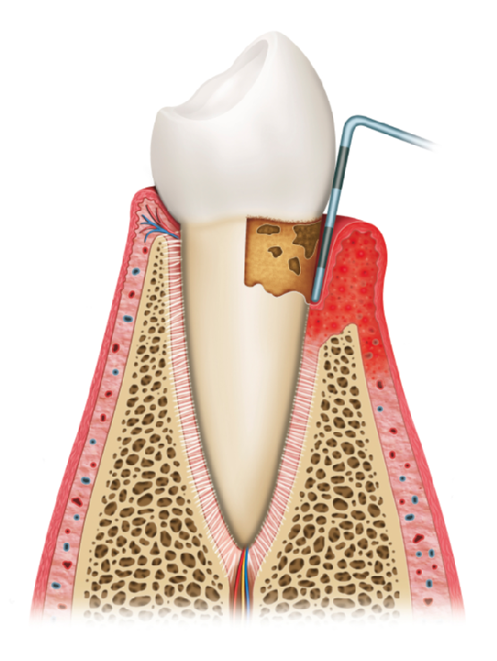 Third stage of gingivitis