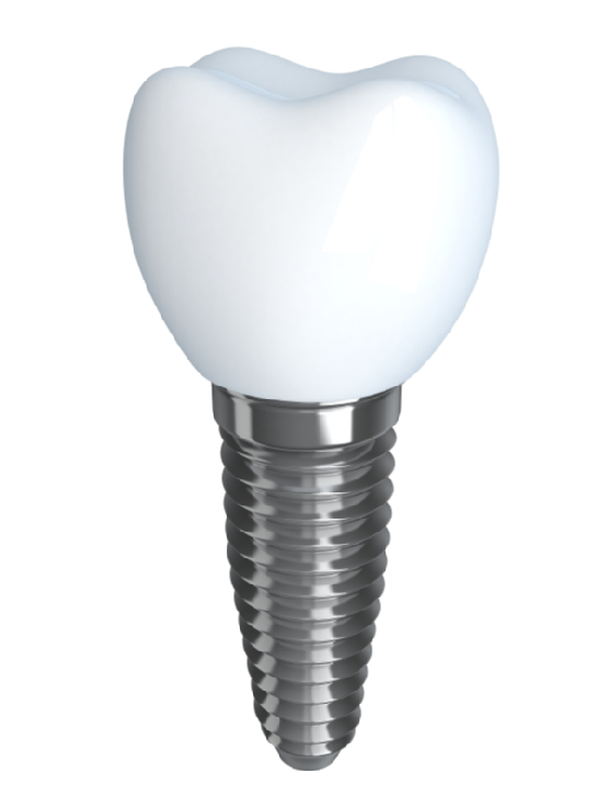 Tooth implant