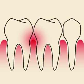 Gum Disease