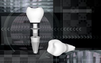 Dental Implants in Chicago