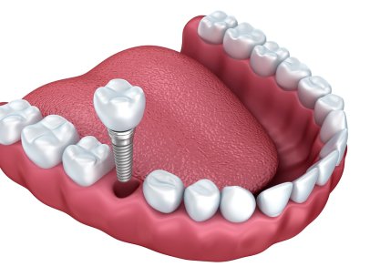 Dental Implant Procedure in Chicago