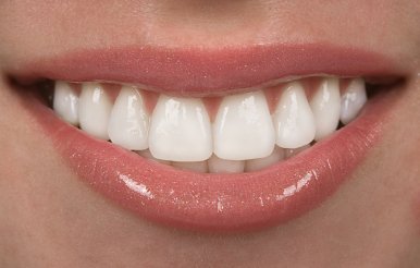 Dental Veneers in Chicago